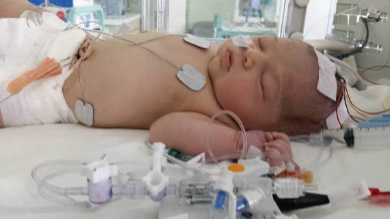 Little Evie had a traumatic birth