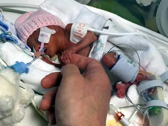 Olivia in hospital after being born at just 23 weeks