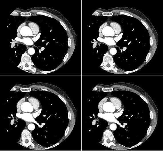 X-ray of the injuries caused by the pellet
