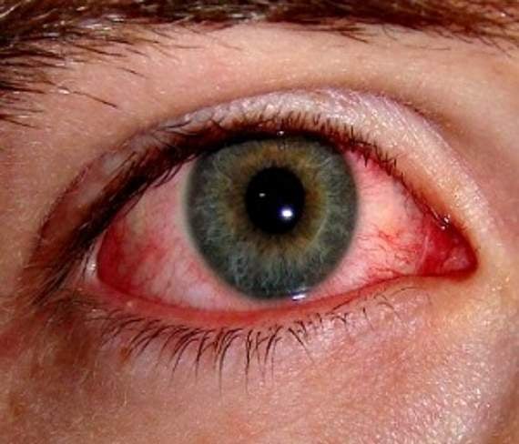 An infected eye after wearing a costume lens