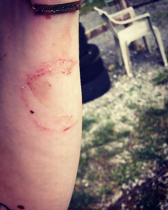 Some of the bites that Ashleigh suffered with.