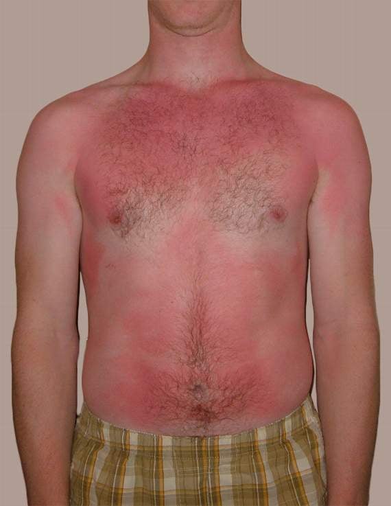 Wikimedia commons: QuinnHK: Sunburn