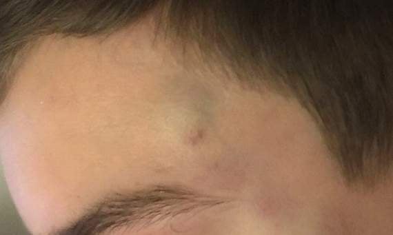 SWNS: A bruise on the pupil’s head