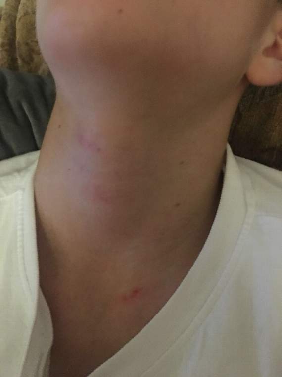 SWNS: Marks on the pupil’s neck