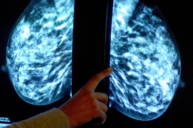 Generic stock picture of a mammogram showing a womans breast in order check for breast cancer at Derby City Hospital.