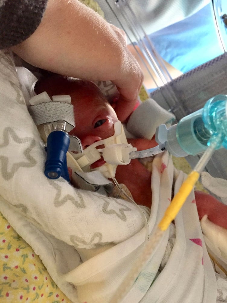 Baby Melanie in the hospital. See SWNS story SWFTpoison. A woman whose unborn child was being "poisoned" in her womb arrived at just 23 weeks- weighing less than a can of beans. Courtney Harvey, 21, was devastated when medics gave her baby- who weighed just 493g- a 10% chance of survival. But Courtney's little girl, one-year-old Melanie Harvey, is now thriving.