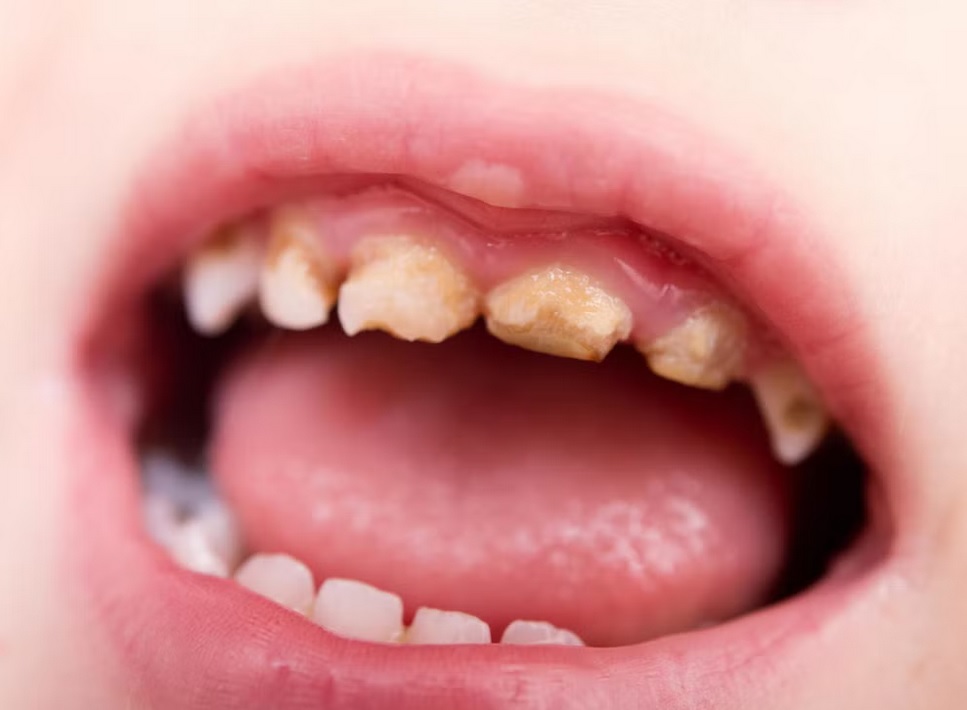 Kids' bad teeth