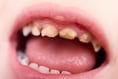 Vote on fluoridation pushed back to next Tynwald sitting