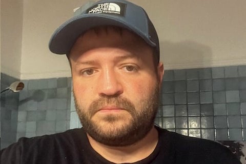 Nicholas Macdonald's damaged nose. // An addict who took 12 grams of ketamine a day which left him needing the loo every 15 minutes was told the "evil" drug would claim his life within a year. Nicholas Koutsandreou Macdonald, 33, says he fell into a bad group aged just 15 after growing up in care. He began taking drugs at illegal raves - including ketamine, which became his go-to to "block out trauma". It spiralled into an eight-year-long addiction which saw him take 12.5g of the drug per DAY - costing over £20k in his eight-year