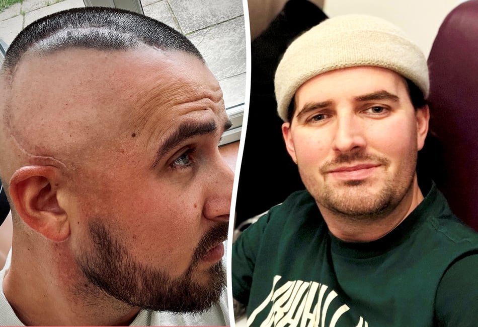 <p>Joshua Baines with his brain tumour surgery scar.</p>