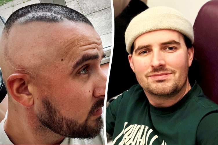 Joshua Baines with his brain tumour surgery scar.