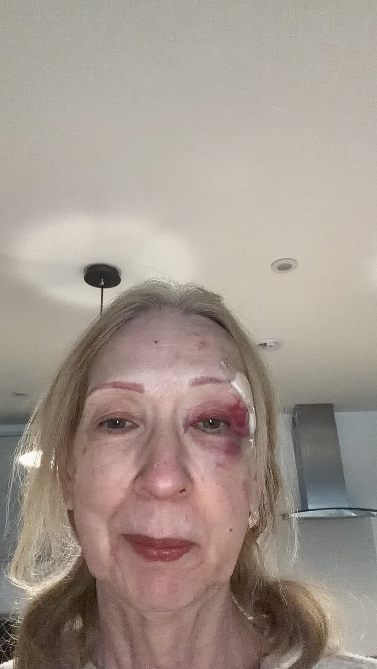 Maureen Black, 67 suffered severe injuries after falling on a root which had been cemented over